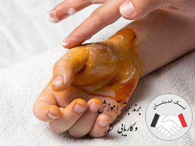 شستشو و پانسمان زخم سوختگی