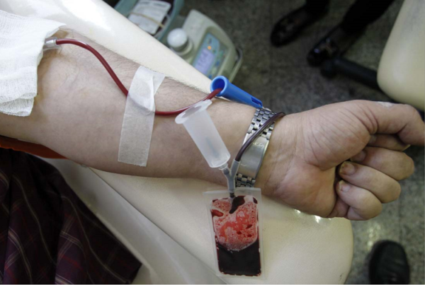 قبل از فصدخون