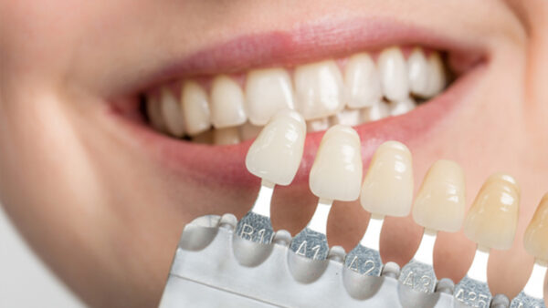 کامپوزیت ونیر دندان